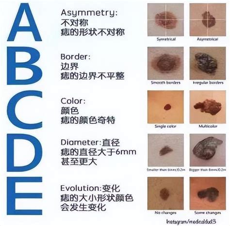 胸部長痣|痣是什麼？會變成黑色素瘤？7種一定要除的痣